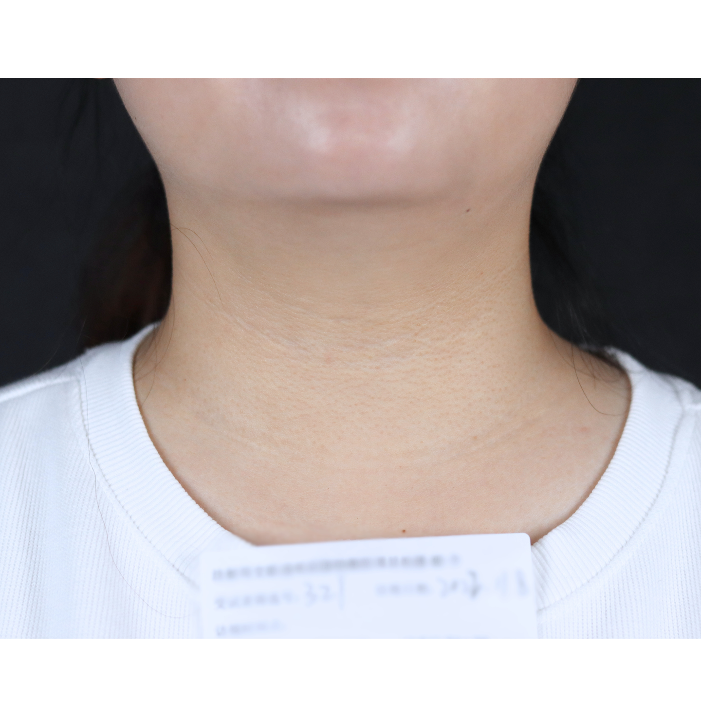 After — Beatrice Derm clinical case: neck, 60 days
