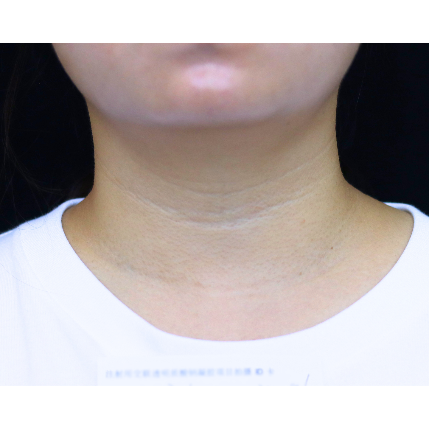 Before — Beatrice Derm clinical case: neck