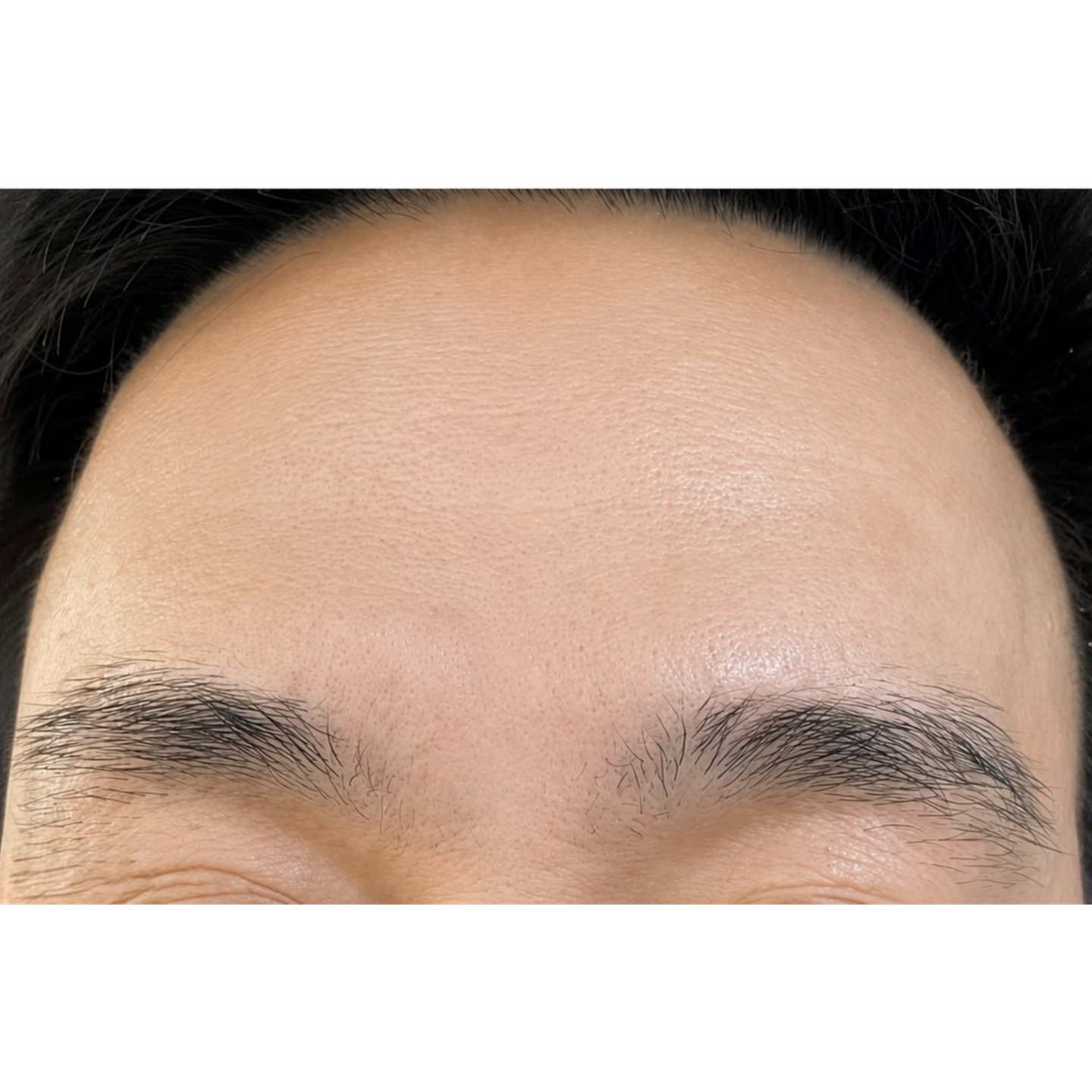 After — Beatrice Derm clinical case: forehead
