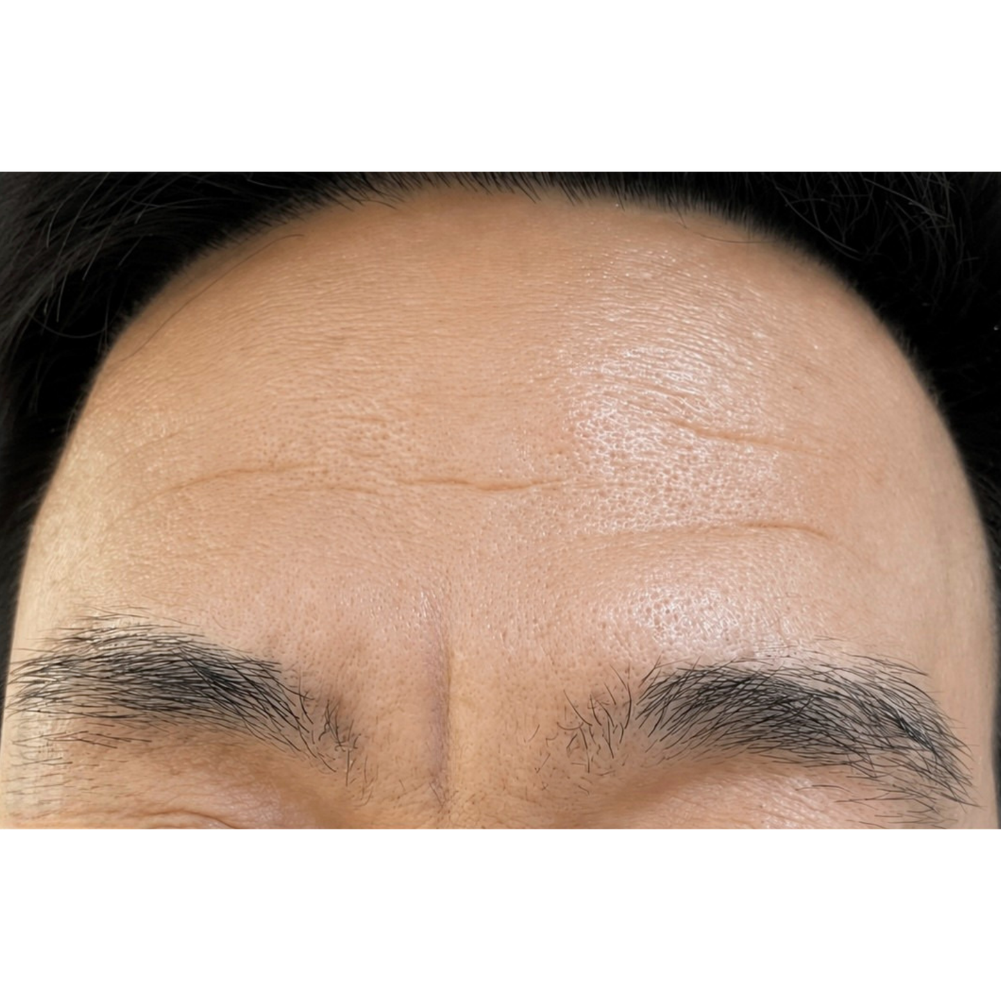Before — Beatrice Derm clinical case: forehead