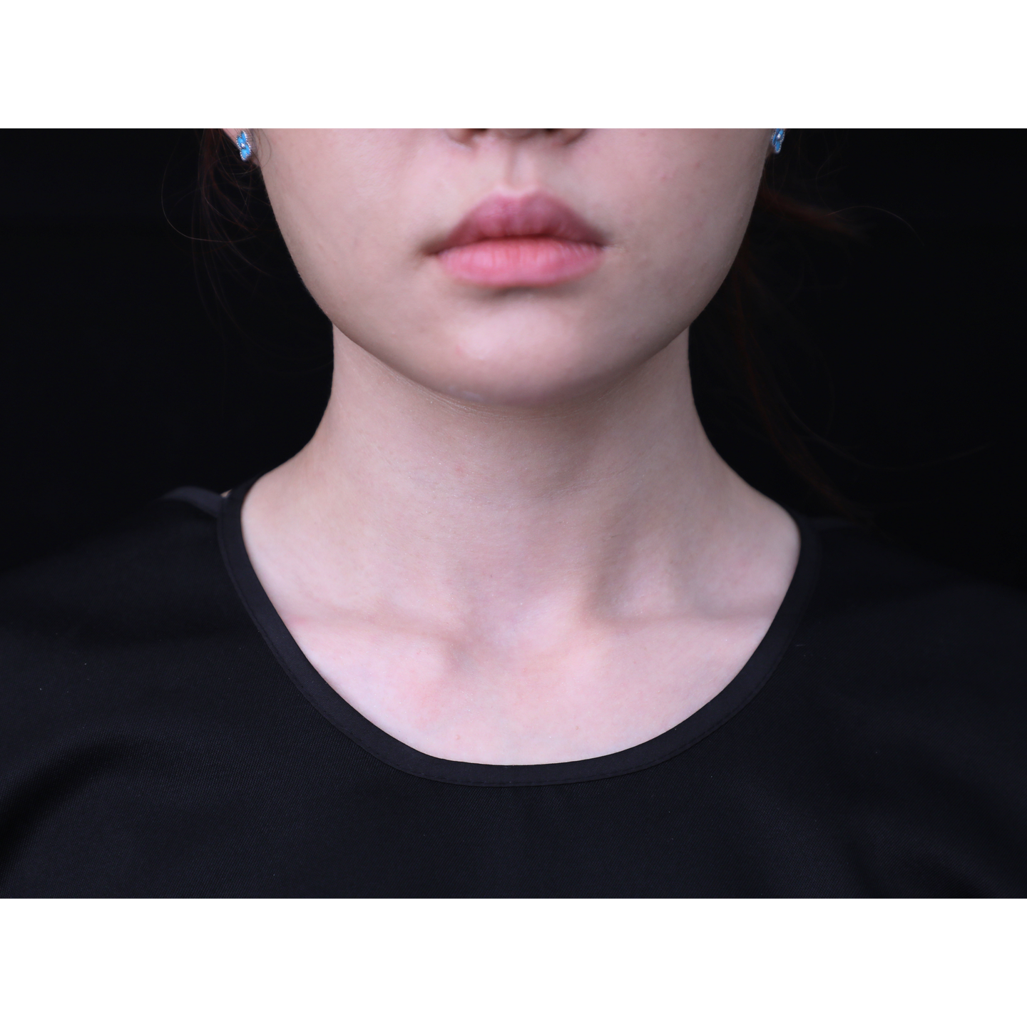 After — Beatrice Finelines clinical case: neck
