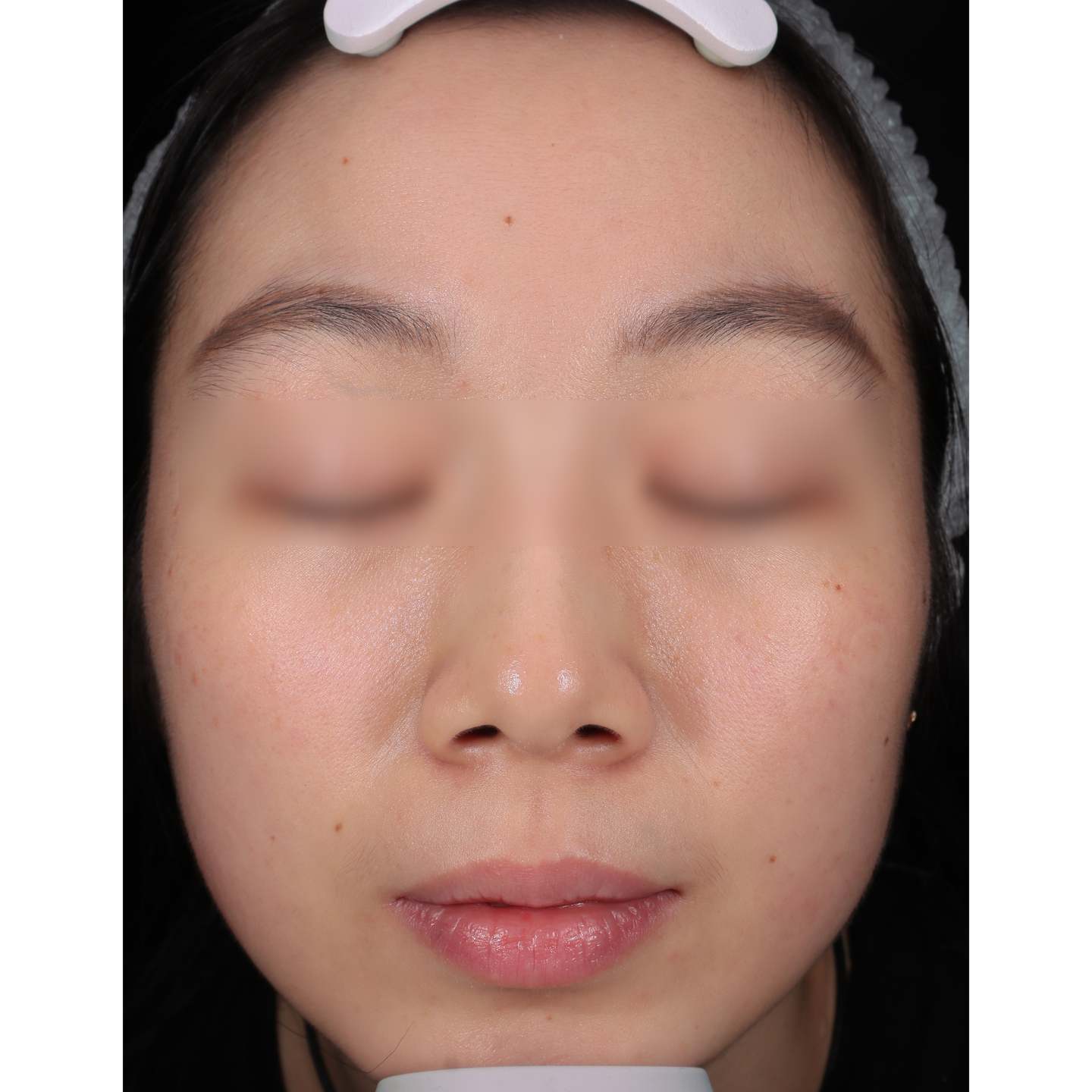 After — Mesonova clinical case