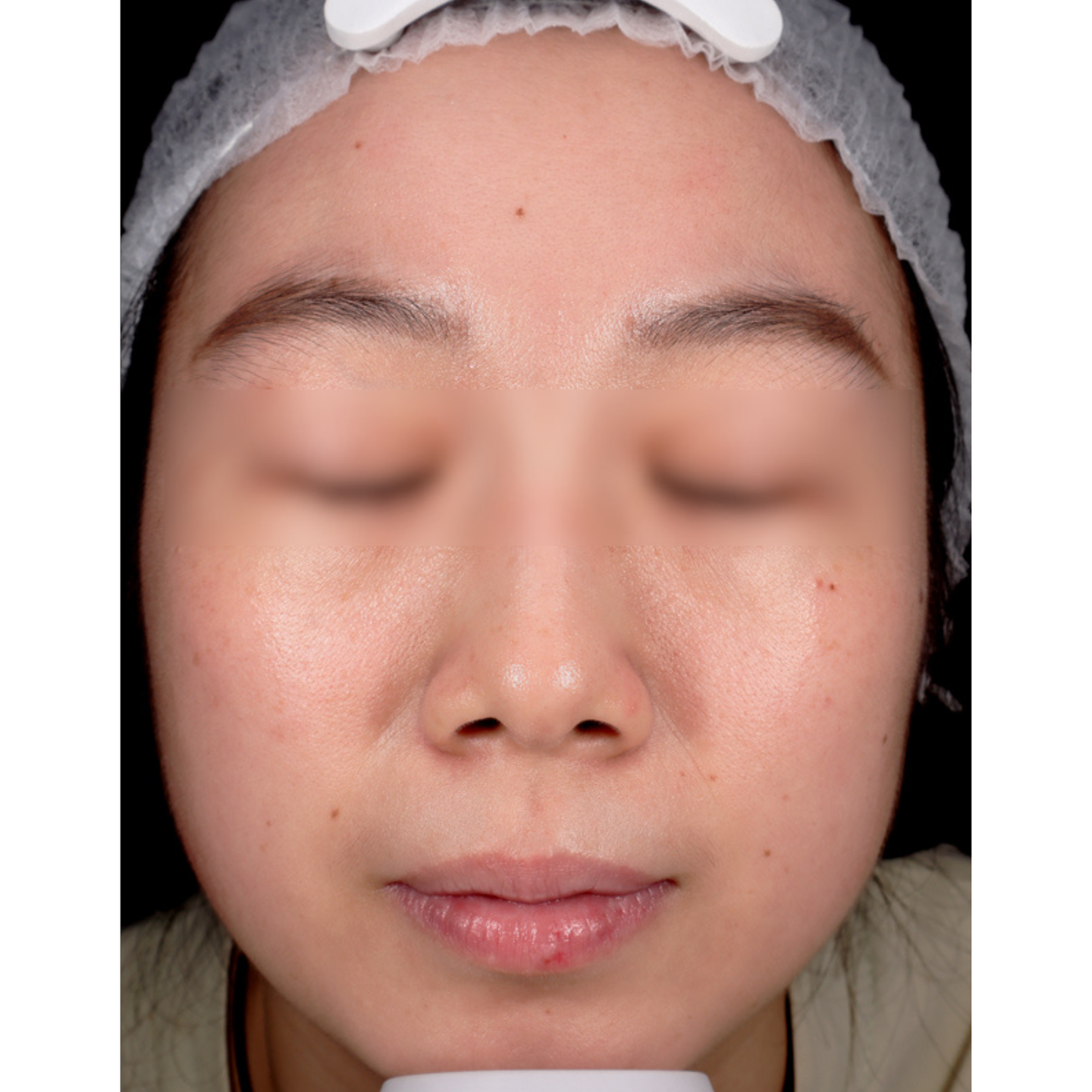 Before — Mesonova clinical case