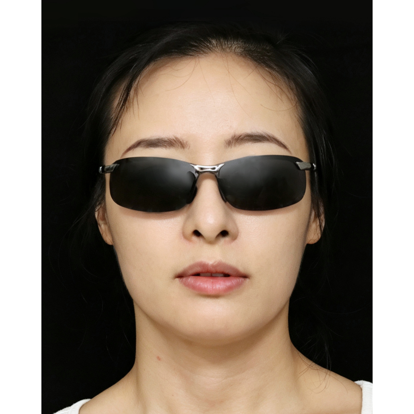 After — Beatrice Restore clinical case: nasolabial folds