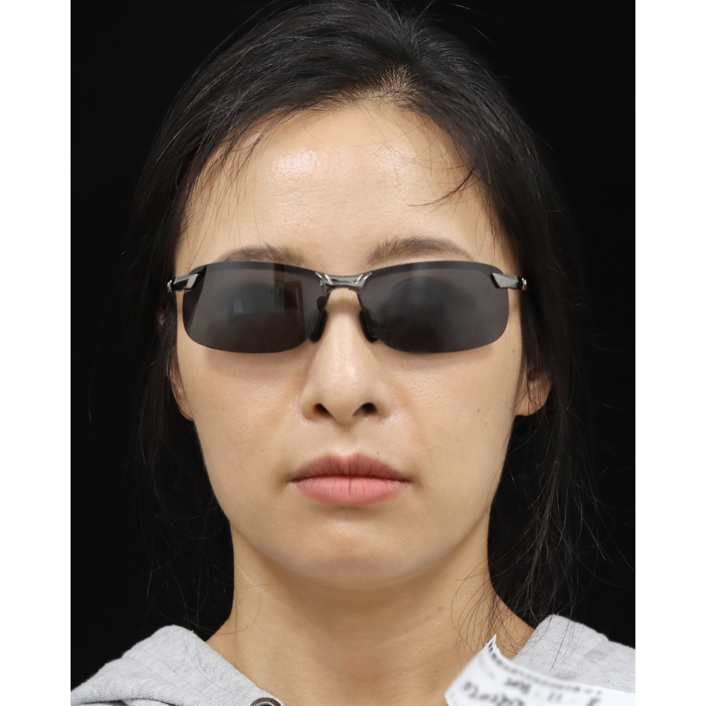 Before — Beatrice Restore clinical case: nasolabial folds