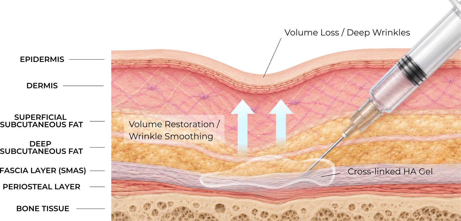 Diagram showing deep dermal or subcutaneous placement of cross-linked hyaluronic acid for facial volume restoration