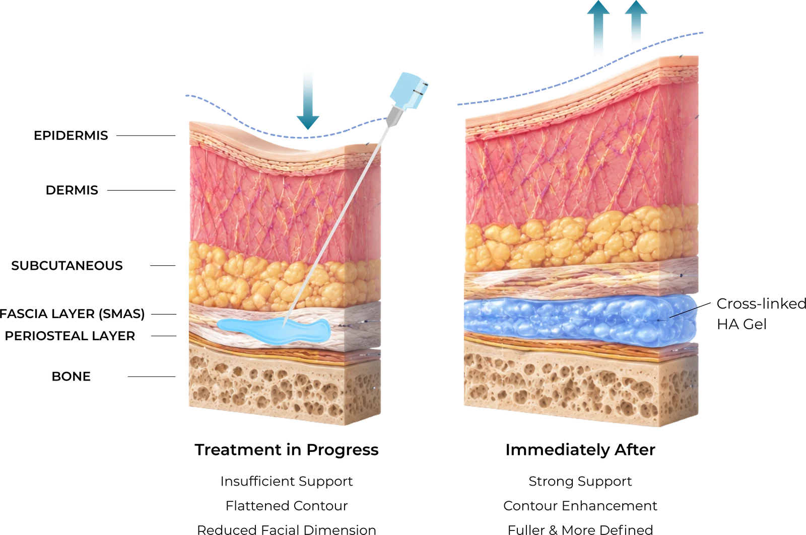 Diagram showing fascial or supraperiosteal placement of cross-linked hyaluronic acid for structural facial contouring