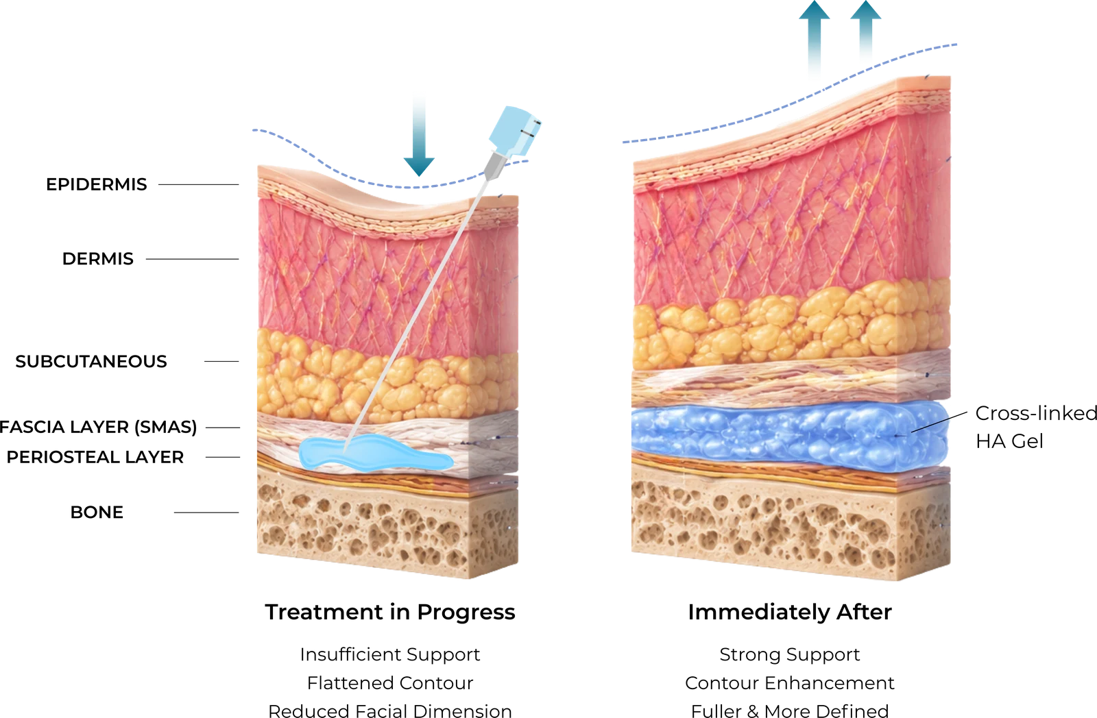 Diagram showing supraperiosteal placement of cross-linked hyaluronic acid for structural facial contouring