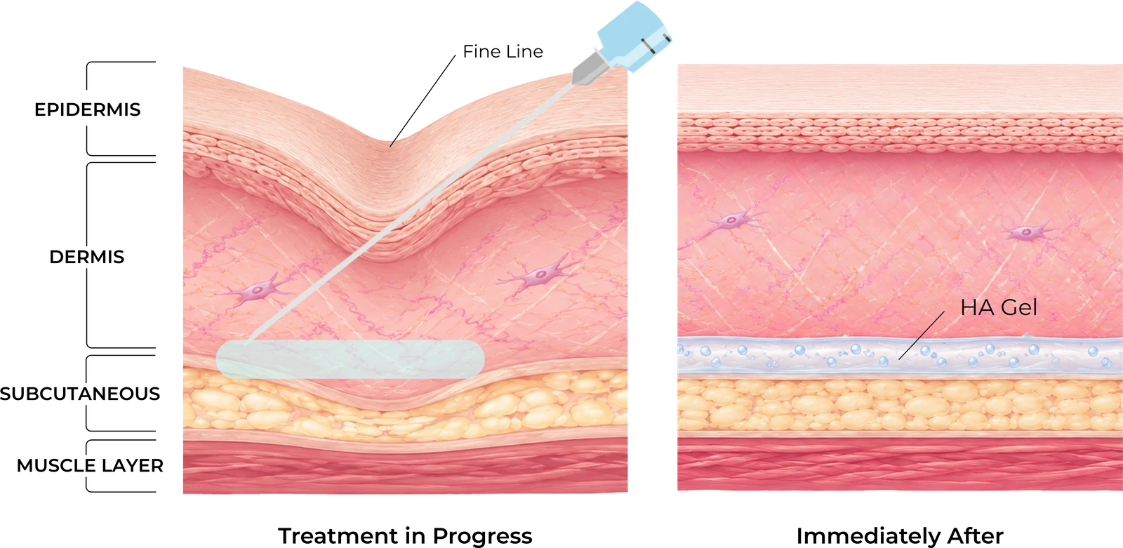 Diagram showing the filling and support effect of lightly cross-linked hyaluronic acid in superficial facial lines