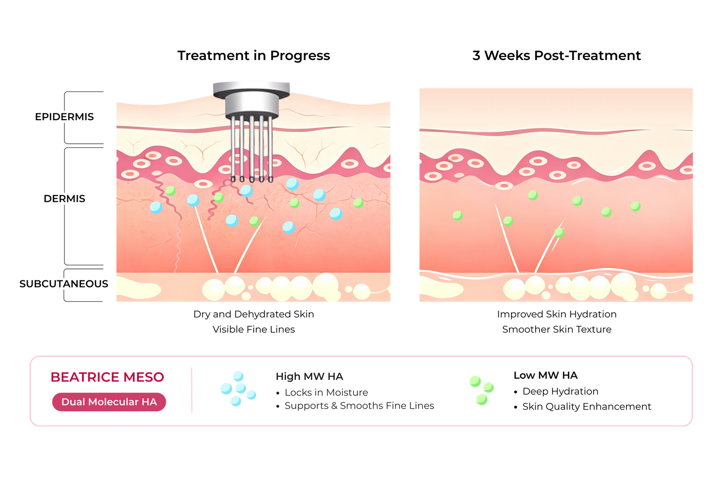Diagram of Beatrice Meso's dual molecular-weight hyaluronic acid hydration system at the skin surface and deep dermis