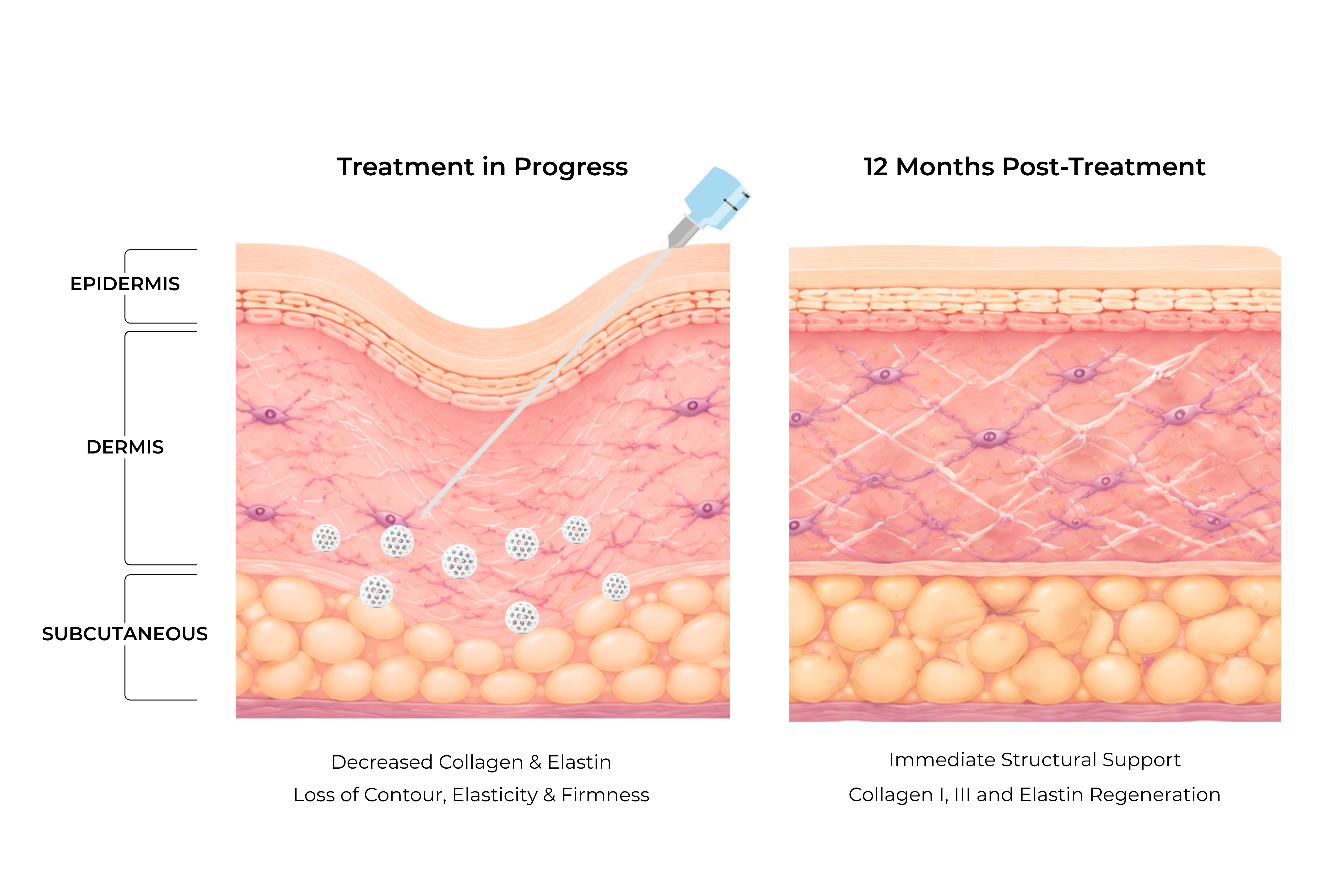 Diagram showing PDLLA microsphere biodegradation and collagen regeneration after deep dermal or subcutaneous injection