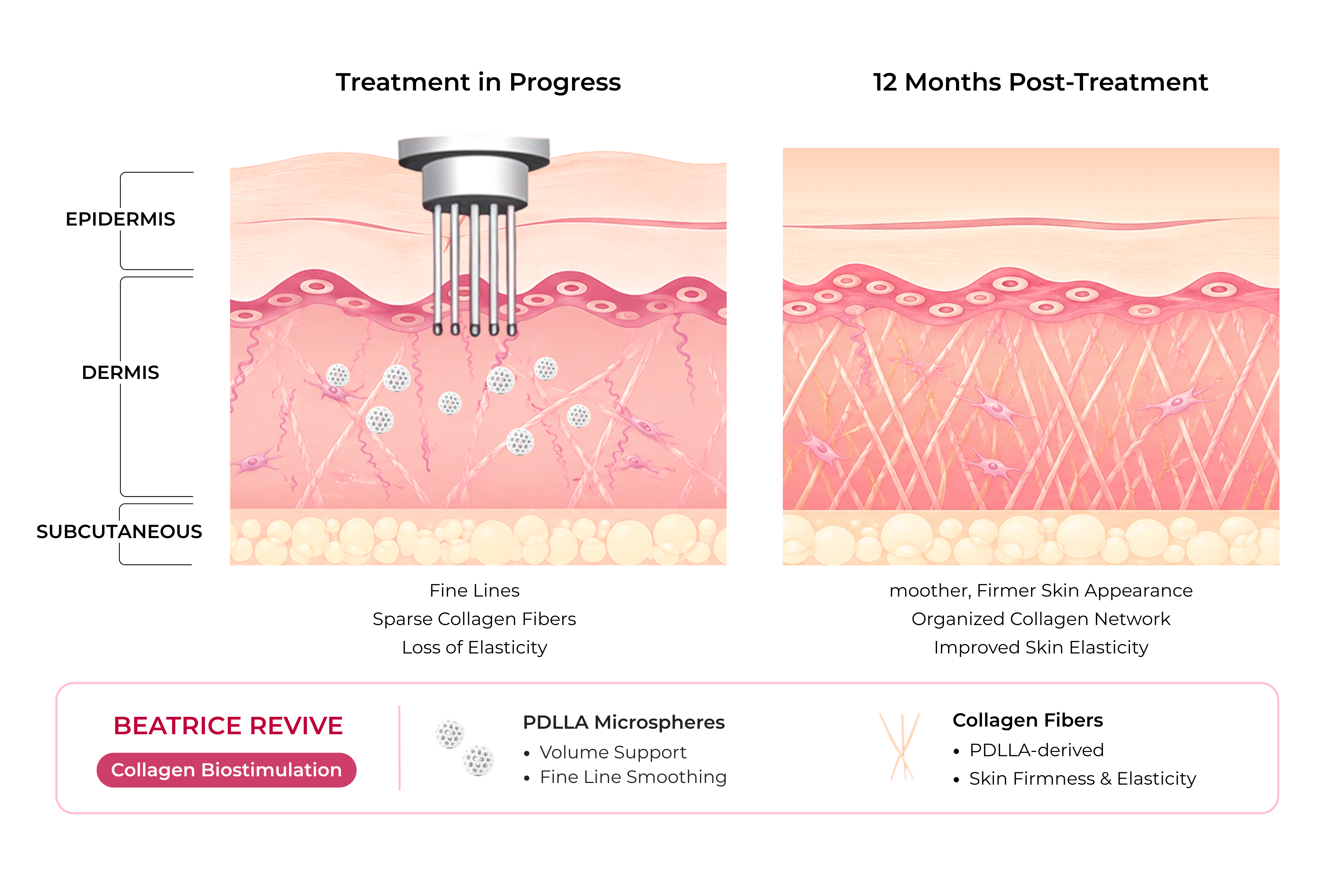 Diagram showing immediate support from PDLLA microspheres followed by collagen and elastin regeneration