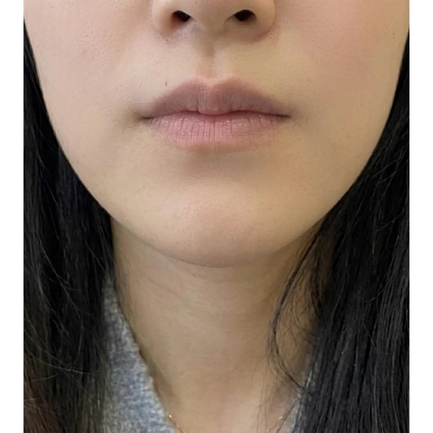 After — Case A — Chin