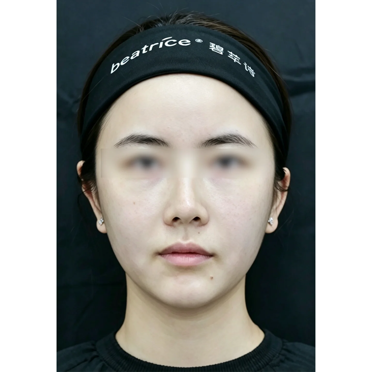 After — Nasolabial folds and marionette lines treatment case